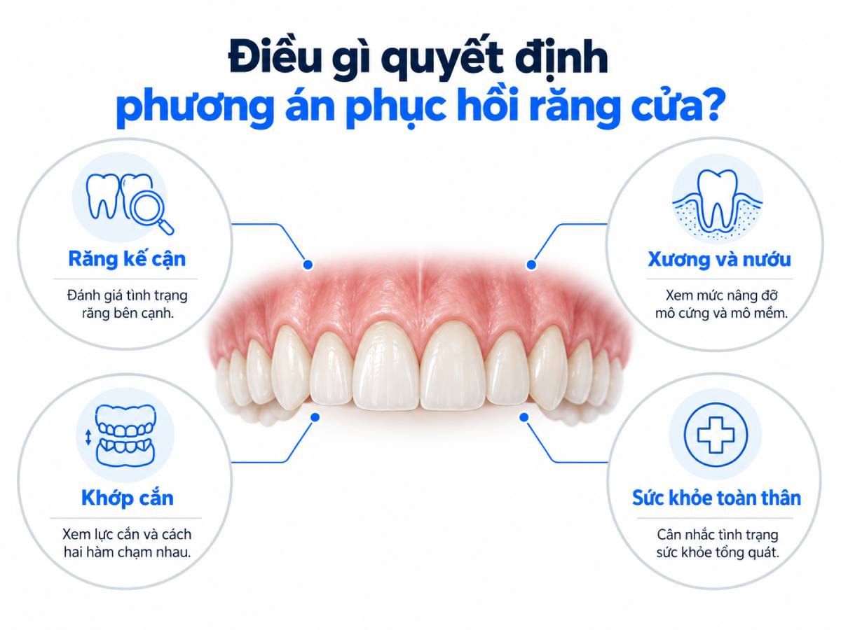 Việc chọn cầu răng, Implant hay phương án khác phụ thuộc vào nhiều yếu tố lâm sàng chứ không chỉ dựa vào số răng mất.